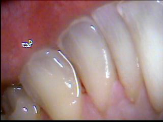 tooth1before